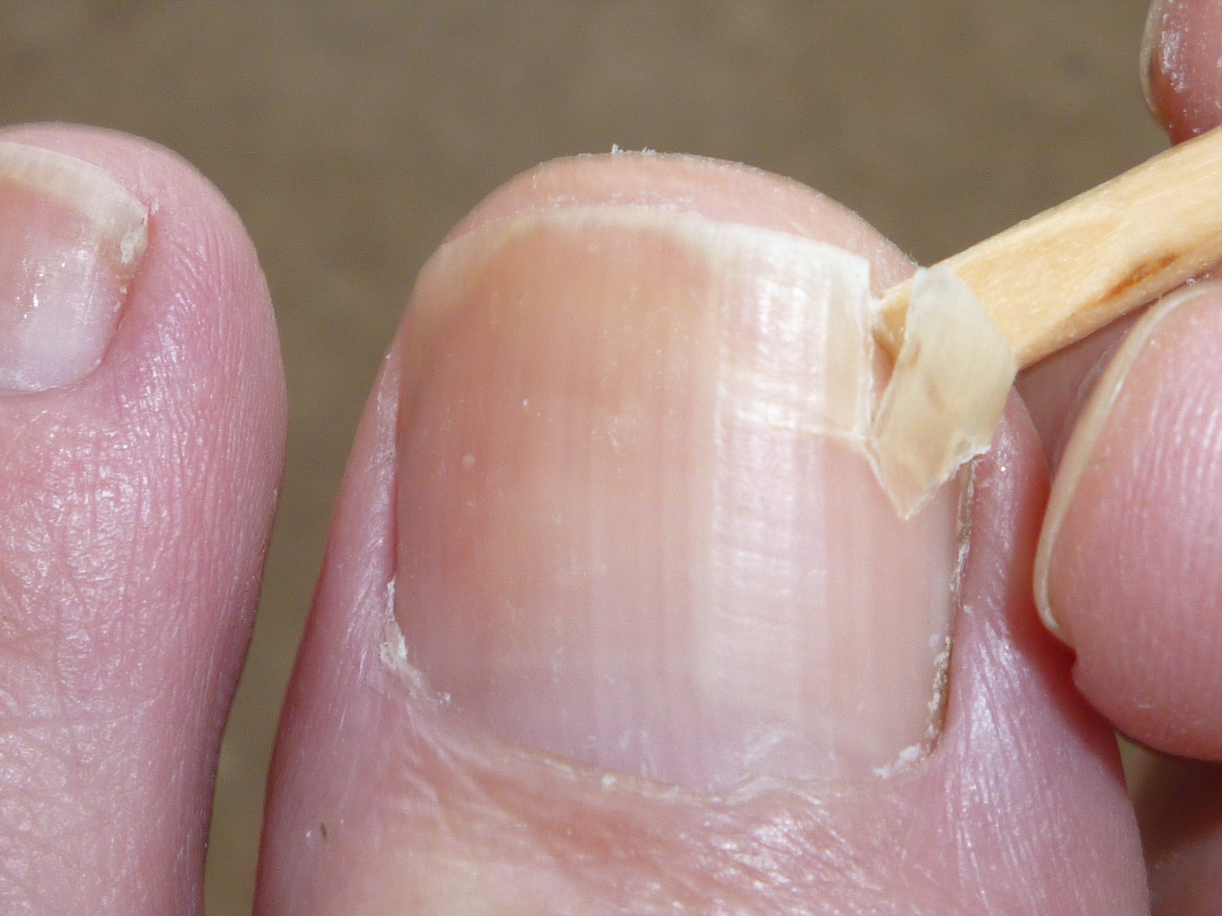 Why is my toenail growing with a crack down the middle ...