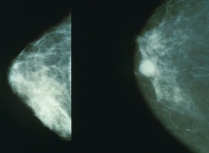Normal  boob, left; cancerous boob, right.